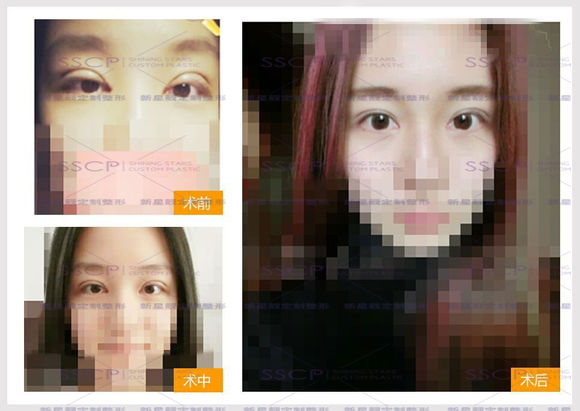 刘风卓双眼皮修复案例