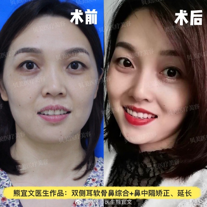 熊宜文_长沙贝美整形技术院长|隆鼻综合整形