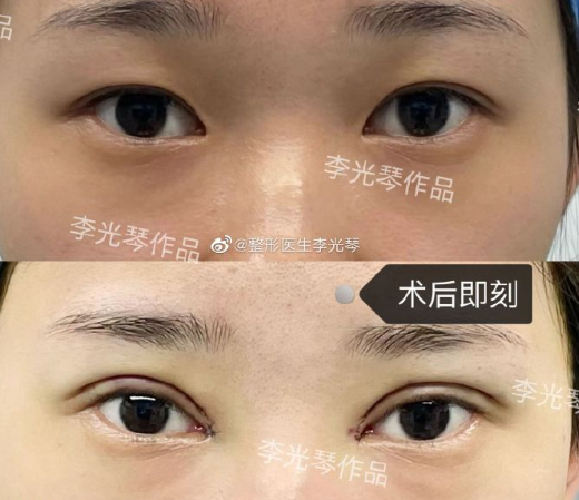 广州双眼皮修复最好的医生是谁