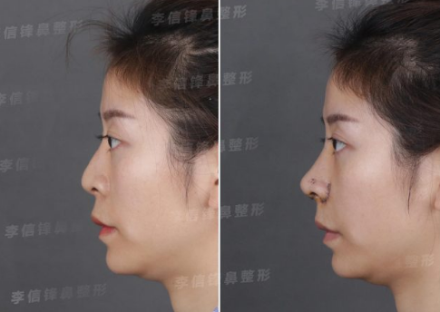 深圳鼻子修复好的专家是谁？李信锋、向宏伟？