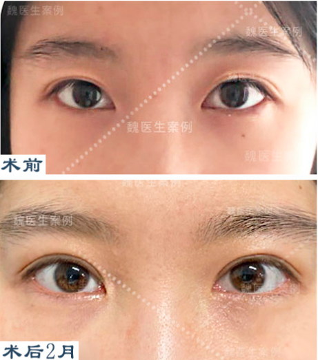 2024年北京双眼皮修复手术最好的医生是谁