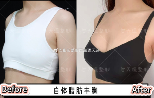 北京贺天遥医生做脂肪丰胸技术怎么样？