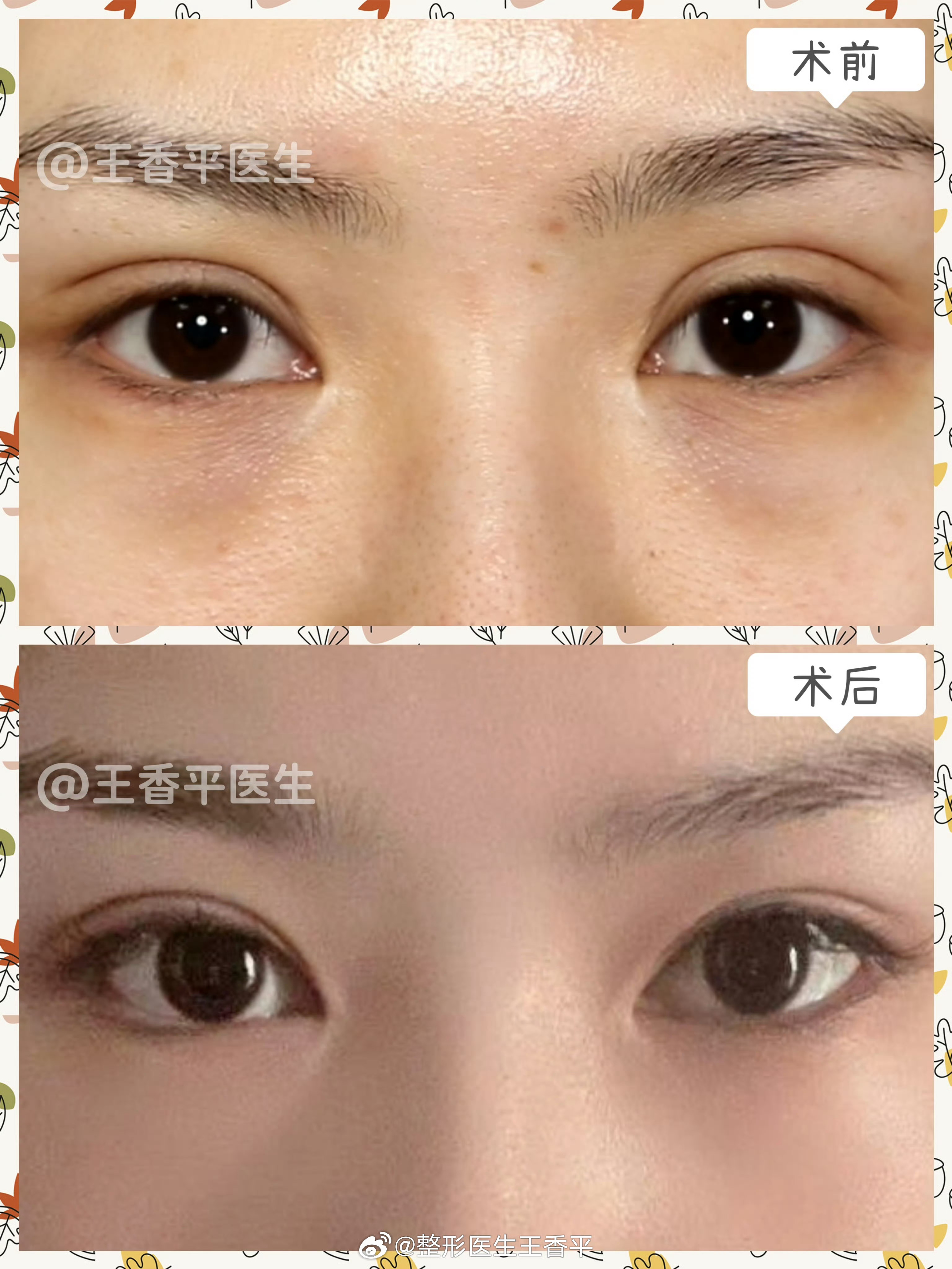 王香平医生修复双眼皮案例
