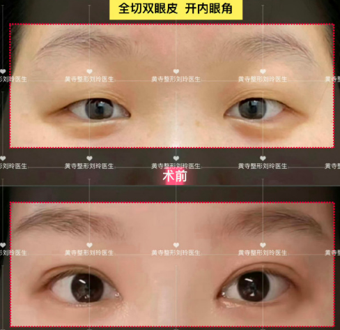 北京刘玲医生做双眼皮修复技术怎么样？