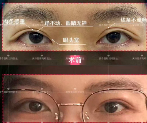 刘玲修复双眼皮案例