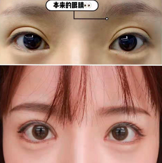 杭州双眼皮修复医生排名哪个最好？
