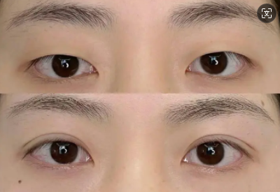 深圳擅长做双眼皮的医生有哪些？